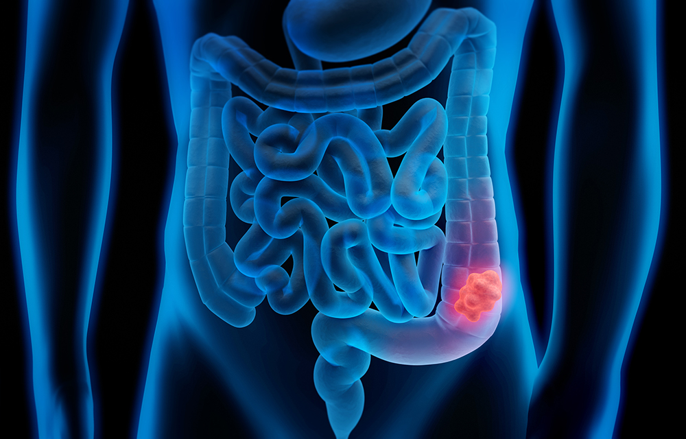 Is a Colonoscopy My Only Choice? Weighing Your Colon Cancer Screening Options